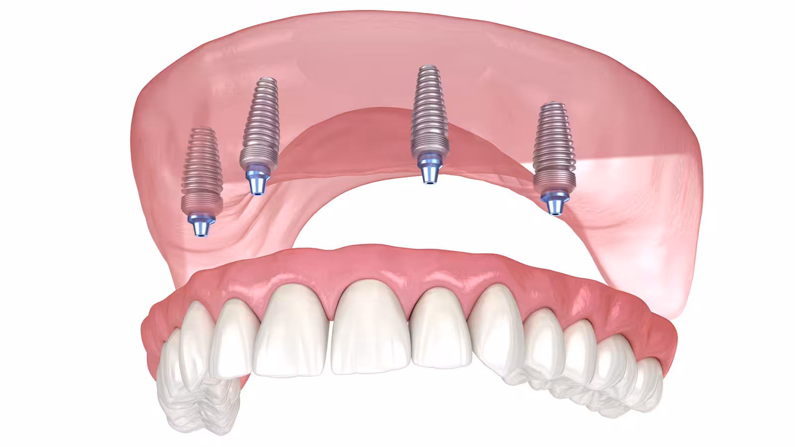 Full arch implant photo