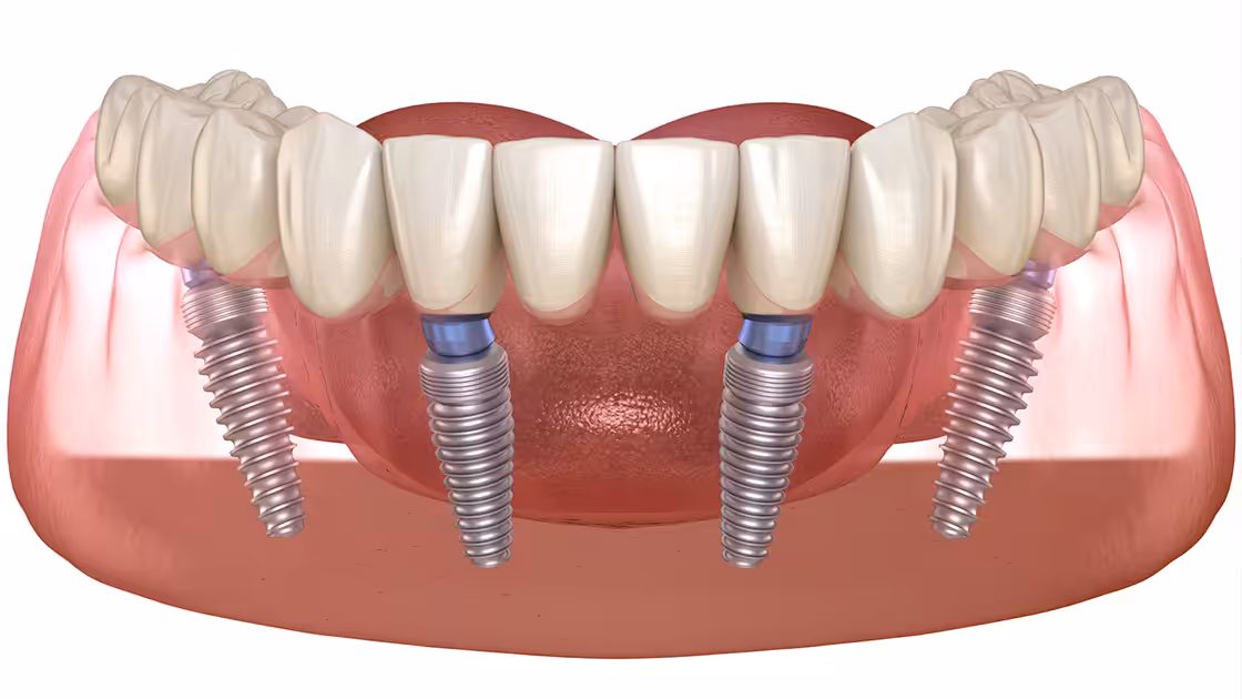 Full arch implant
