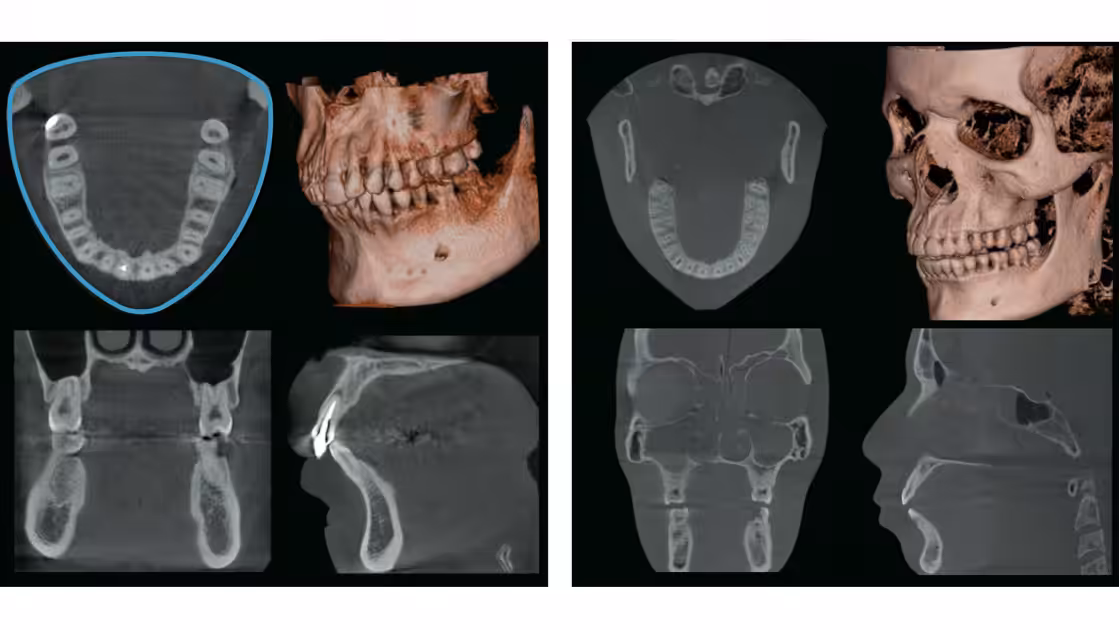Guided implant placement photo