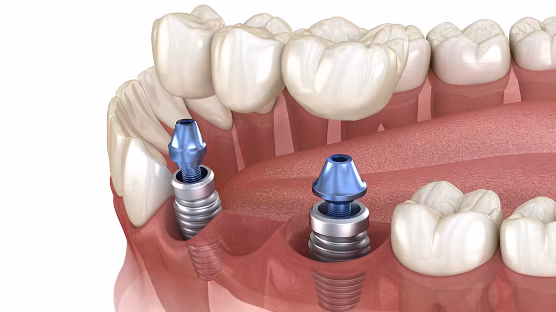 Implant bridge photo