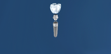 Implant button3