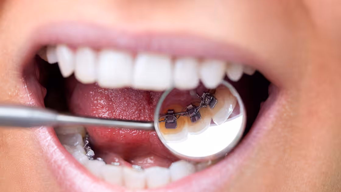 Lingual braces reflected in mirror