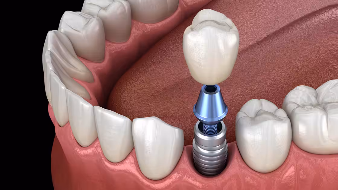 Single implant photo